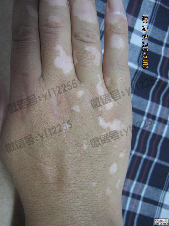 武汉环亚中医白癜风医院