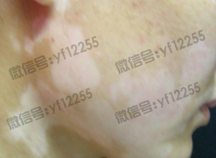 武汉环亚中医白癜风医院